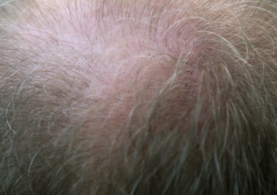 Hair Follicle Drug Test: What Does It Detect and How Long Is the Detection Period?